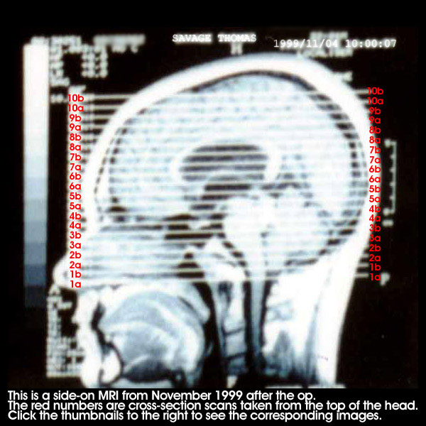 This is a side-on MRI. The red numbers are cross sections taken from the top of the head - click the thumbnails to the right to see those images